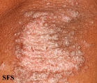 pityriasis rubra pilaris
