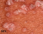 pityriasis rubra pilaris
