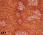 pityriasis rubra pilaris