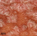 pityriasis rubra pilaris