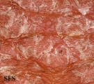 pityriasis rubra pilaris