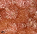 pityriasis rubra pilaris