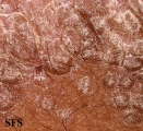 pityriasis rubra pilaris