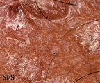 pityriasis rubra pilaris