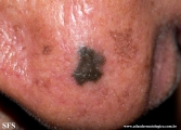 melanoacanthoma
