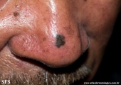 melanoacanthoma