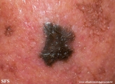melanoacanthoma