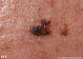 melanoacanthoma