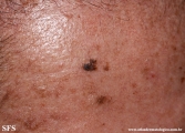 melanoacanthoma