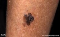melanoacanthoma