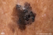 melanoacanthoma