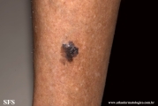melanoacanthoma