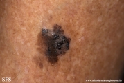 melanoacanthoma