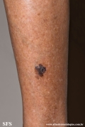 melanoacanthoma