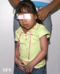hartnup disease