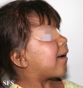 hartnup disease