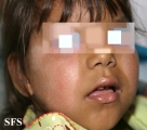 hartnup disease
