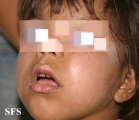 hartnup disease