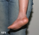 hartnup disease