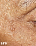 eccrine hidrocystoma