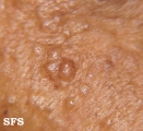 eccrine hidrocystoma