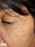 eccrine hidrocystoma