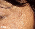 eccrine hidrocystoma