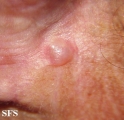 eccrine hidrocystoma