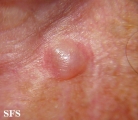 eccrine hidrocystoma