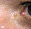 eccrine hidrocystoma