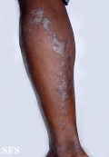lichen planus linearis