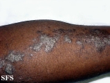 lichen planus linearis
