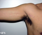 lichen planus linearis