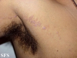 lichen planus linearis