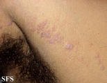 lichen planus linearis