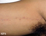 lichen planus linearis