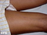 lichen planus linearis
