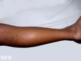 lichen planus linearis