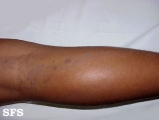lichen planus linearis