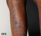 lichen planus linearis