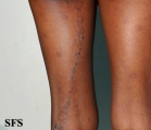 lichen planus linearis