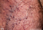 angiokeratoma of the scrotum