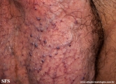 angiokeratoma of the scrotum