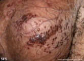 angiokeratoma of the scrotum