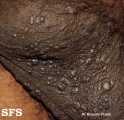 angiokeratoma of the scrotum