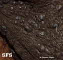 angiokeratoma of the scrotum