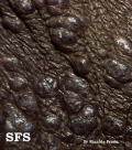 angiokeratoma of the scrotum