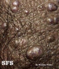 angiokeratoma of the scrotum