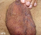 angiokeratoma of the scrotum