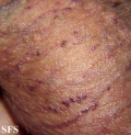 angiokeratoma of the scrotum